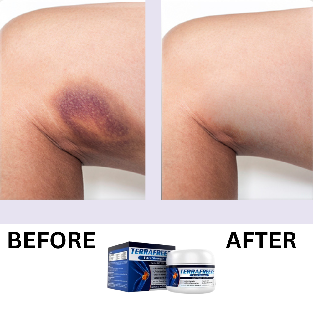 Before and after bruise healing comparison showing faster recovery with TERRAFREEZE