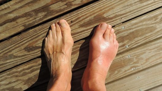 feet-gout-symptoms.jpg